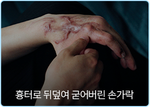 흉터로 뒤덮여 굳어버린 손가락