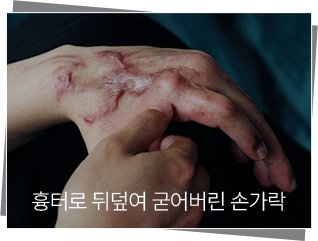흉터로 뒤덮여 굳어버린 손가락