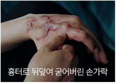 흉터로 뒤덮여 굳어버린 손가락