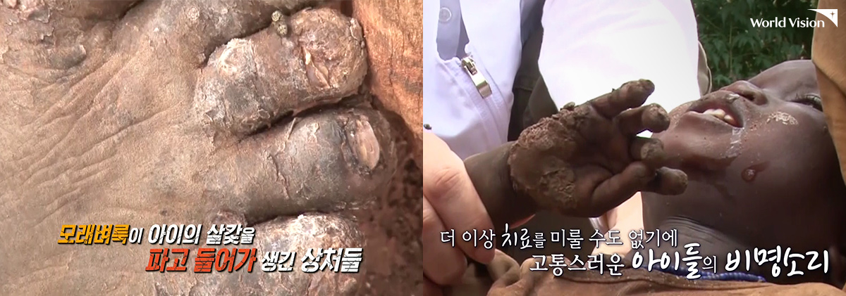 손과 발에 깊게 파고 든 모래 벼룩으로, 말할 수 없는 고통을 겪고 있었죠.