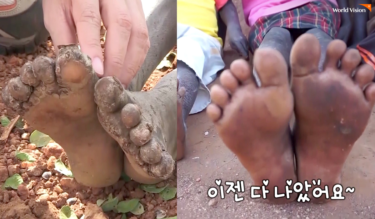 손과 발에 가득했던 모래벼룩 상처들, 꾸준한 치료를 통해 말끔히 나았어요.